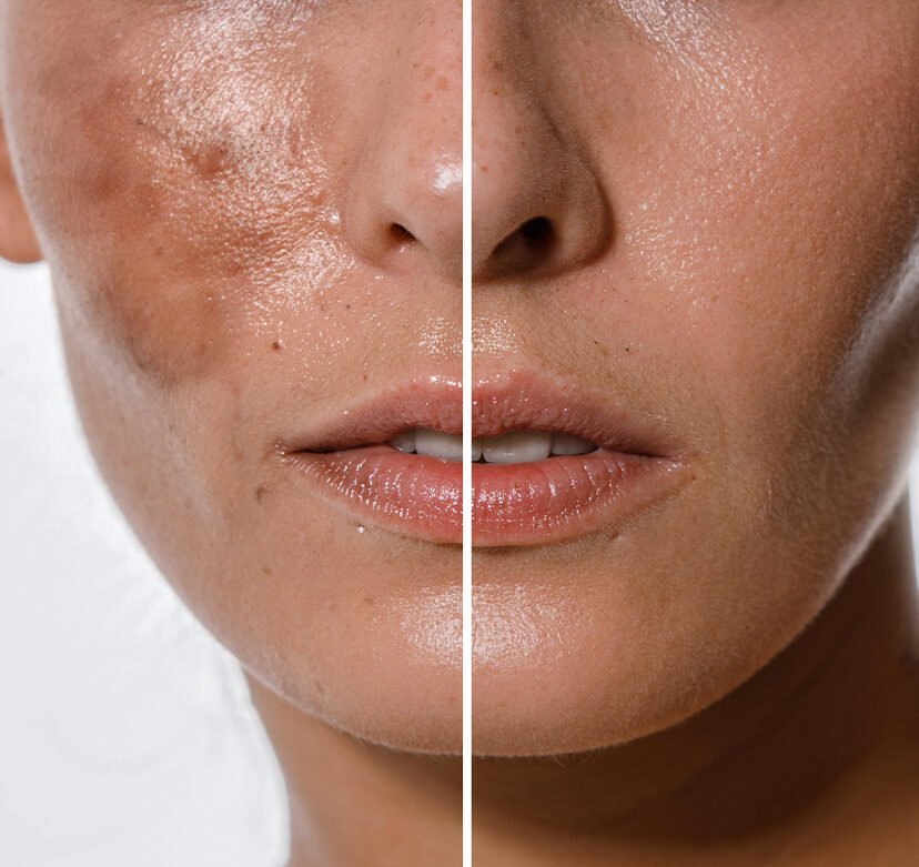 Hyperpigmentation explained