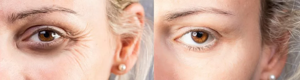 Ways to diminsh Crows Feet. 